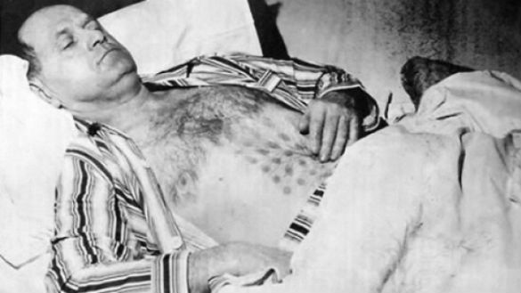 Stefan Michalak was treated at a hospital for burns to his chest and stomach that later turned into raised sores on a grid-like pattern.